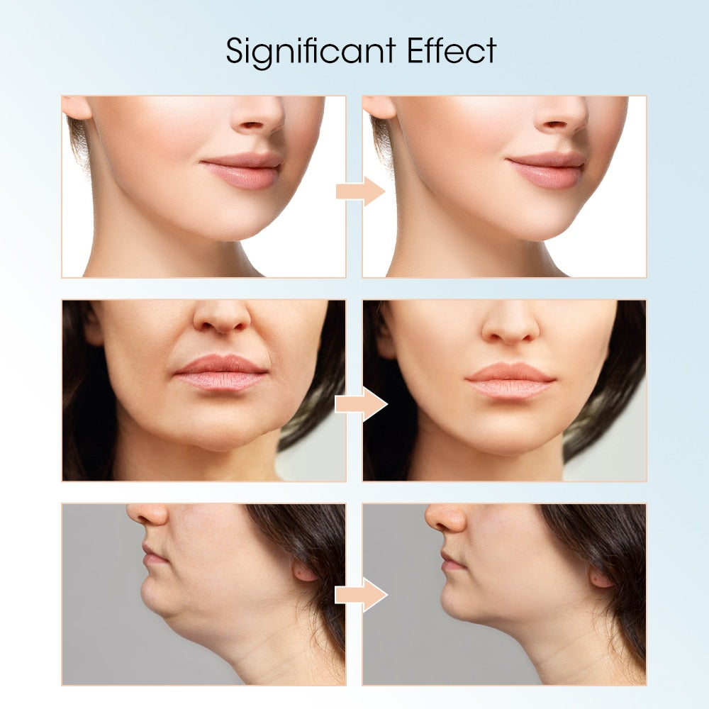 V-Chin - Master Facial Tightener